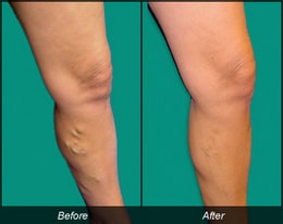 Before and after vein treatment of shin