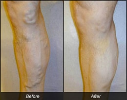 Before and after vein treatment of leg