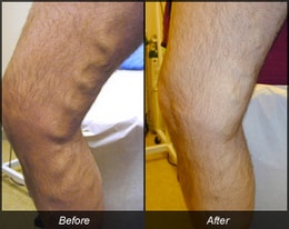 Before and after vein treatment of leg