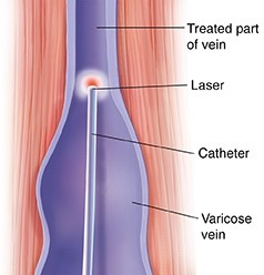 Diagram of vein treatment