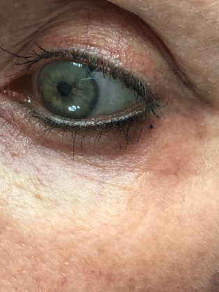 Eyelid after vein treatment