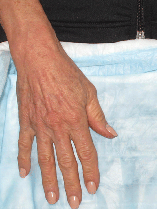 Hand after vein treatment