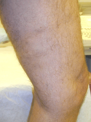 Inside of thigh after vein treatment