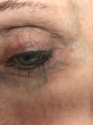 Eyelid before vein treatment