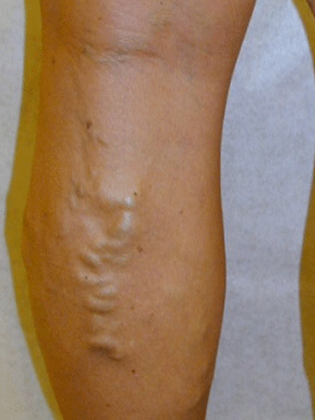 Back of leg before vein treatment