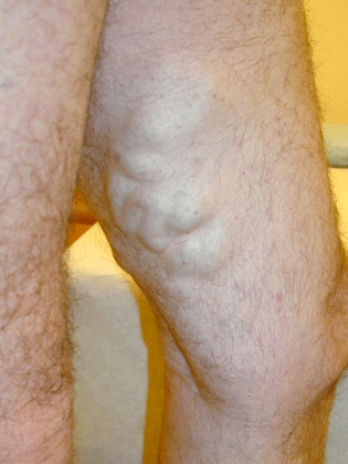 Inside of thigh before vein treatment