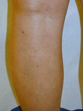 Back of leg after vein treatment