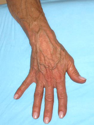 Hand before vein treatment