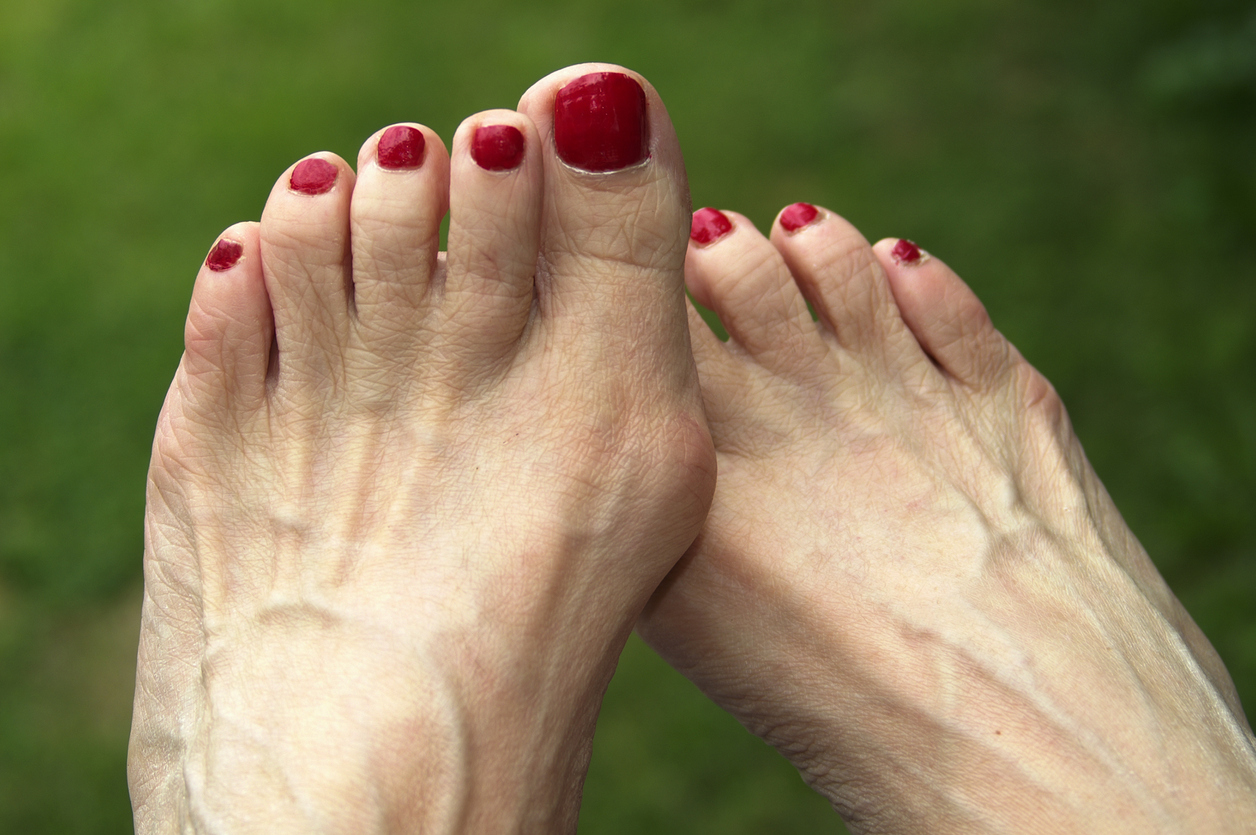 Prominent foot veins